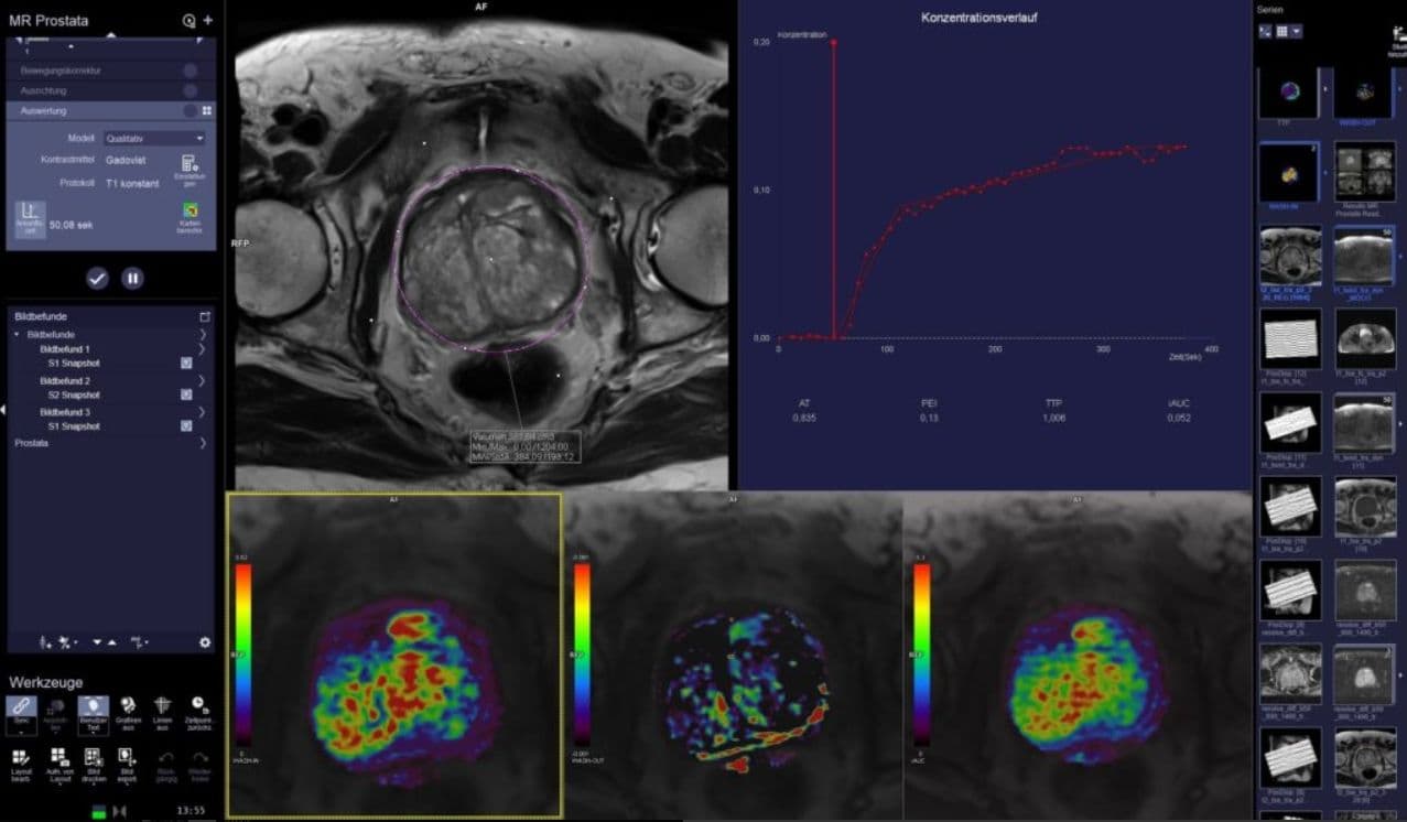 Prostate Diagnostics