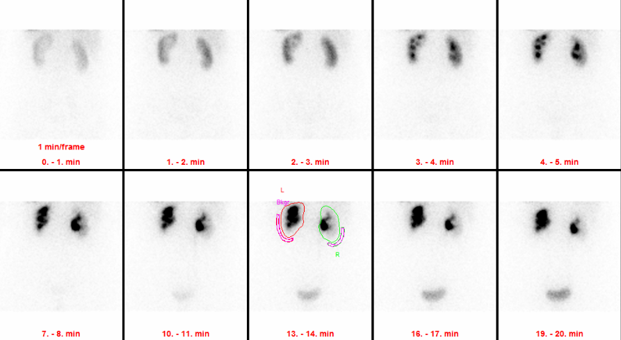 Renal scintigraphy (MAG3 & DMSA)